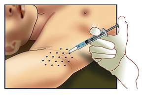 botoxaxhidrosis