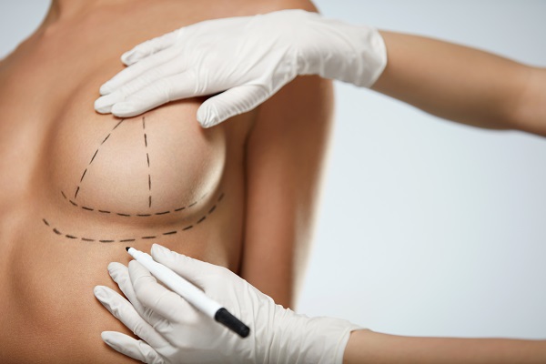 Incision Markings on a Female Breast