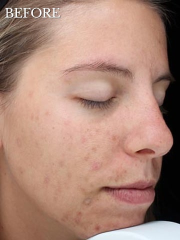 young woman with acne before chemical peel