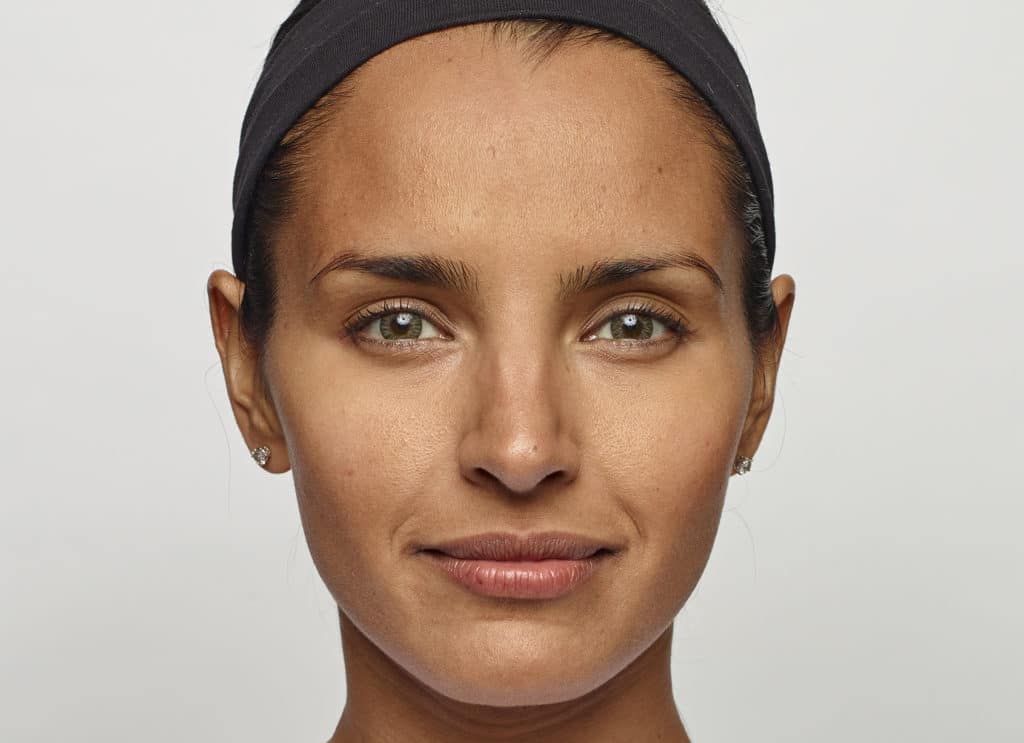 woman after dysport injections, smoother forehead