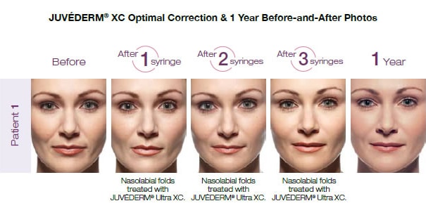 juvederm before and after 1