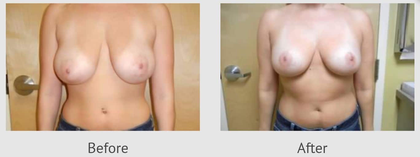 breast reduction before and after front view east greenwich RI