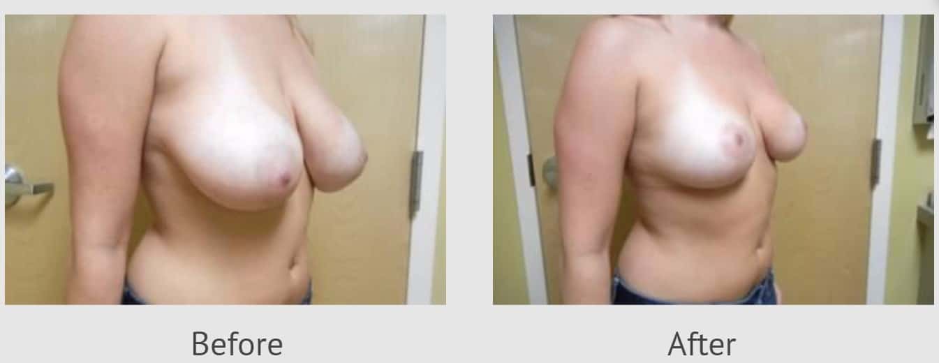 breast reduction before and after side view east greenwich RI