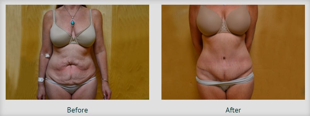 tummy tuck before and after east greenwich RI