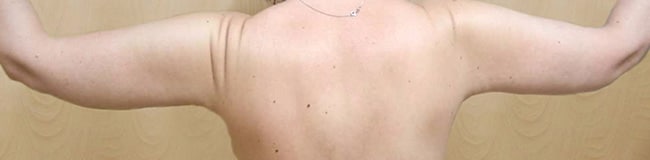 After Image: Arm Lift - back