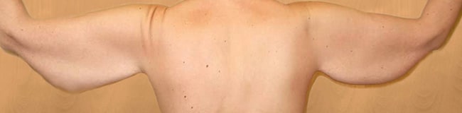 Before Image: Arm Lift - back