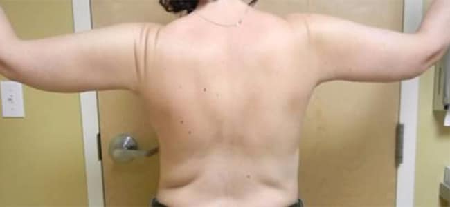 After Image: Arm Lift - back