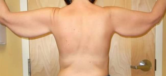 Before Image: Arm Lift - back