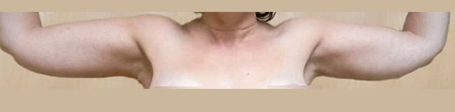 After Image: Arm Lift - front