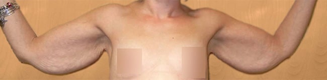 Before Image: Arm Lift - front