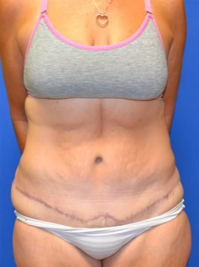 After Image: Tummy Tuck - front