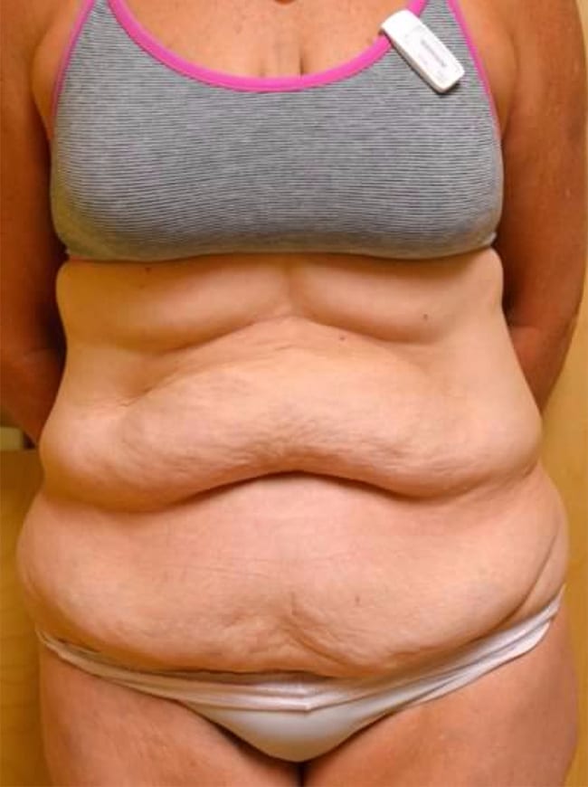 Before Image: Tummy Tuck - front
