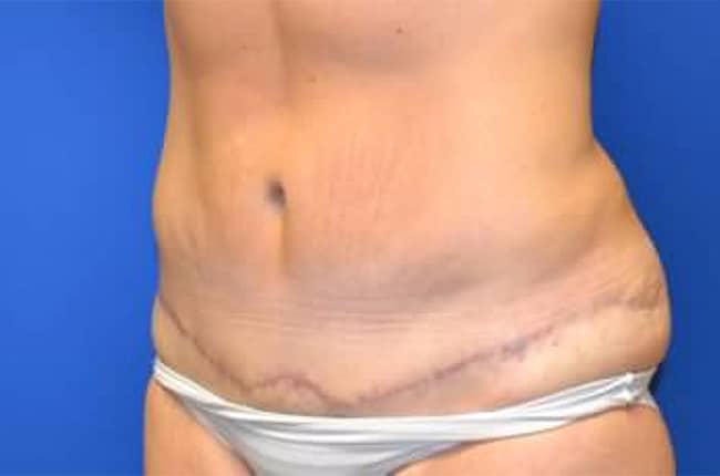 After Image: Tummy Tuck - left-front-oblique