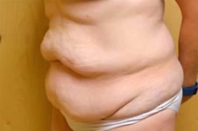 Before Image: Tummy Tuck - left-front-oblique
