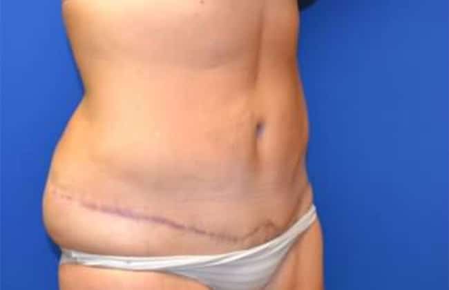 After Image: Tummy Tuck - right-front-oblique