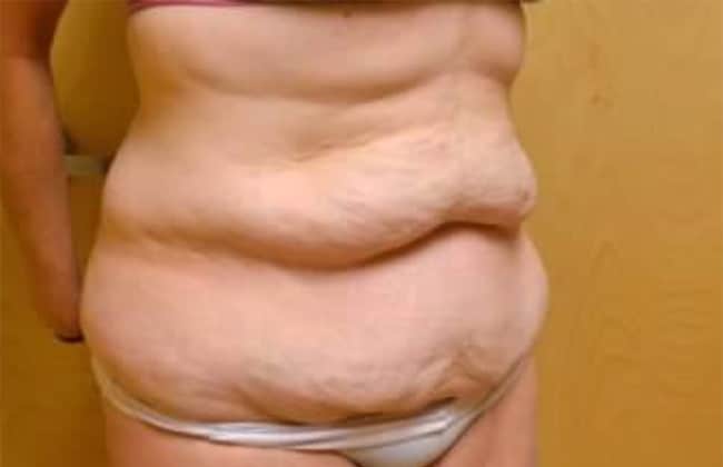 Before Image: Tummy Tuck - right-front-oblique