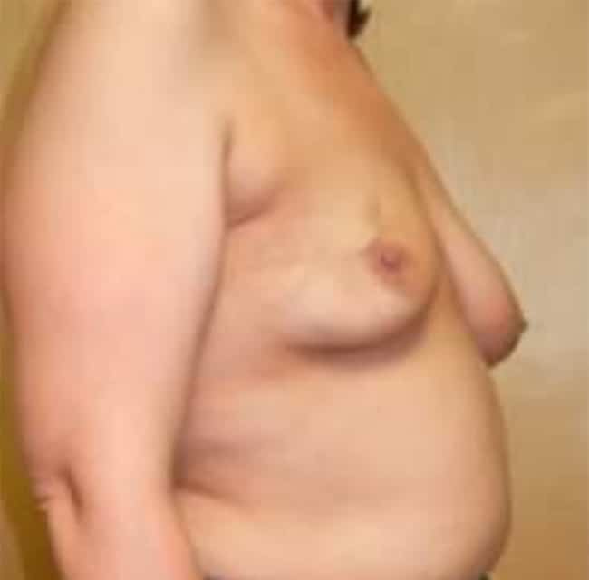 Before Image: Breast Reconstruction - right-front-oblique