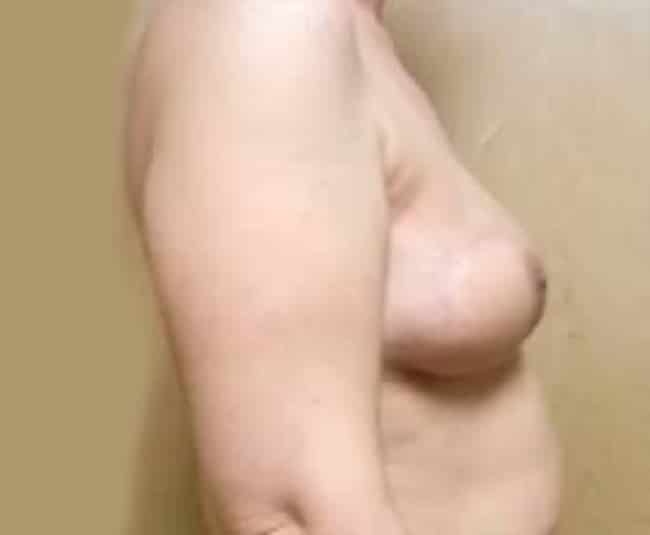 After Image: Breast Reconstruction - right-side