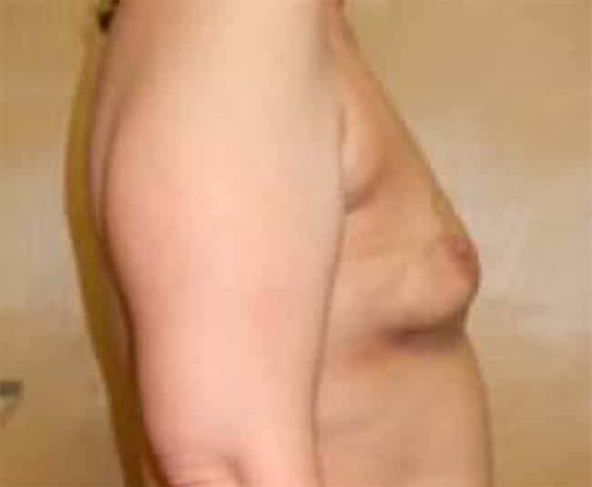 Before Image: Breast Reconstruction - right-side