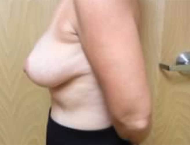 After Image: Breast Reduction - left-side