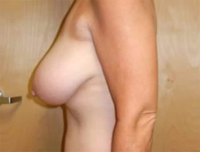 Before Image: Breast Reduction - left-side