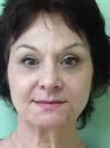 After Image: Blepharoplasty