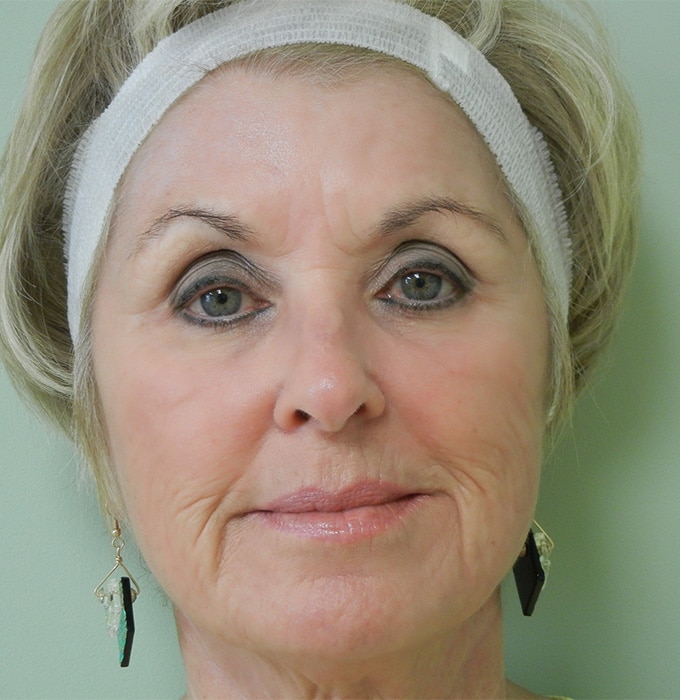 After Image: Fractional Non-Ablative Laser Resurfacing - front