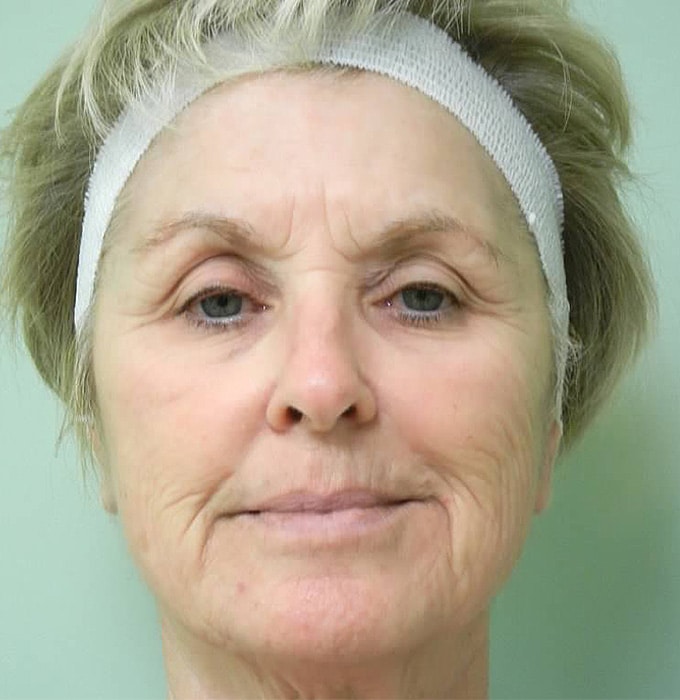 Before Image: Fractional Non-Ablative Laser Resurfacing - front