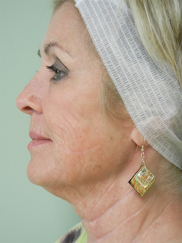 After Image: Fractional Non-Ablative Laser Resurfacing - left-side