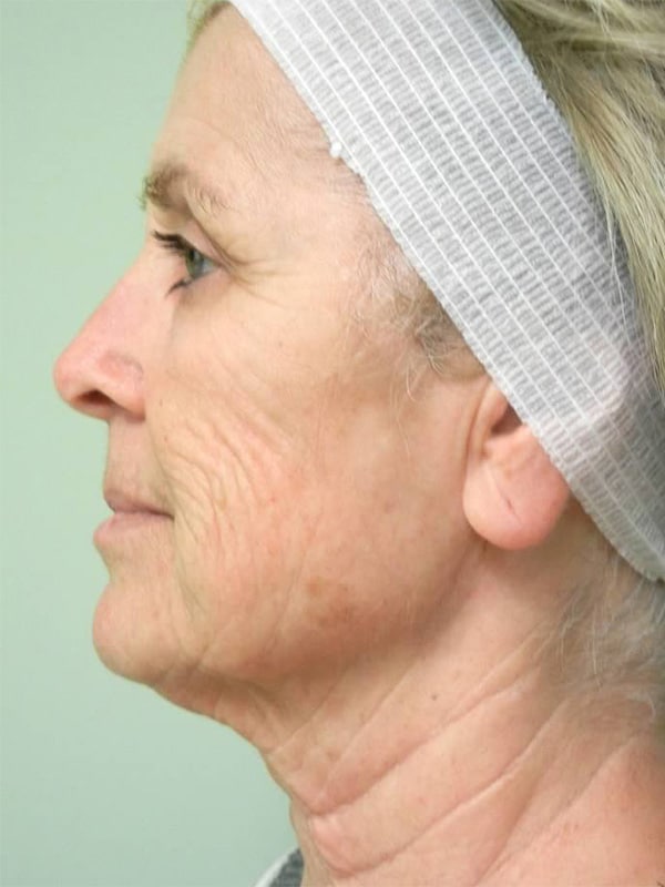 Before Image: Fractional Non-Ablative Laser Resurfacing - left-side