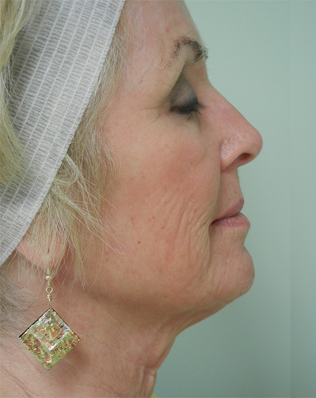 After Image: Fractional Non-Ablative Laser Resurfacing - right-side