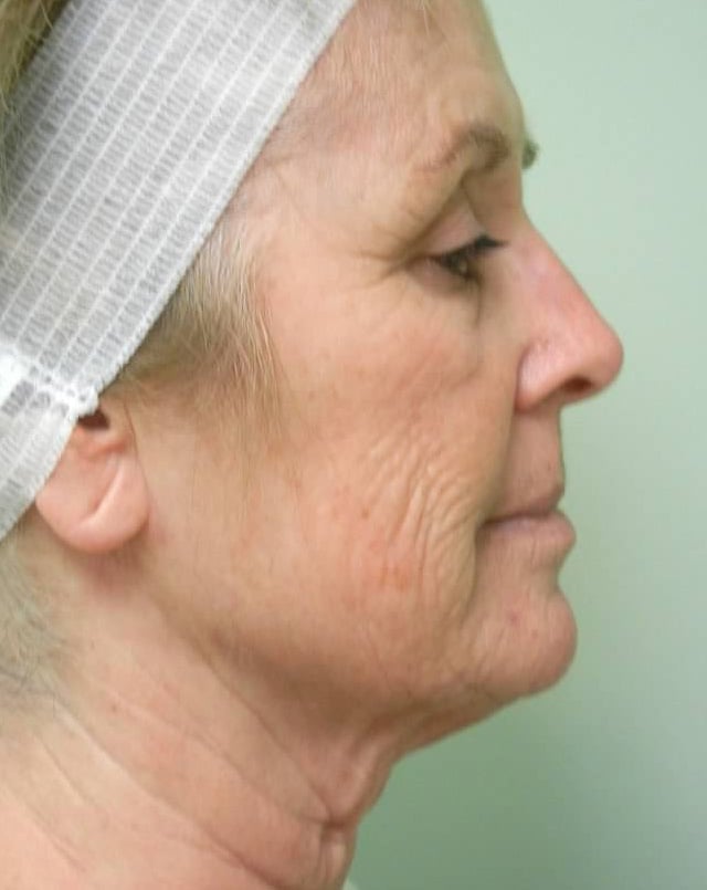 Before Image: Fractional Non-Ablative Laser Resurfacing - right-side