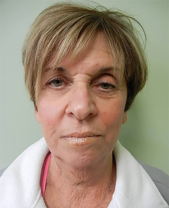 After Image: Juvederm Voluma Injection - front