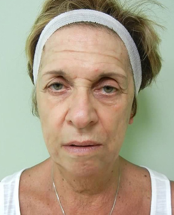 Before Image: Juvederm Voluma Injection - front