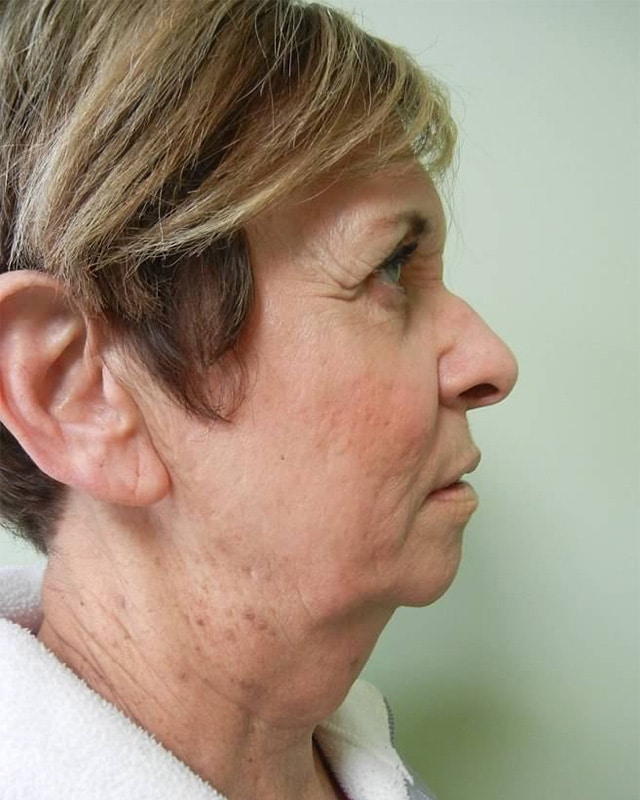After Image: Juvederm Voluma Injection - right-side