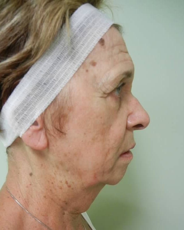 Before Image: Juvederm Voluma Injection - right-side