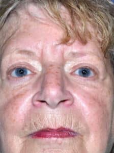 After Image: Blepharoplasty