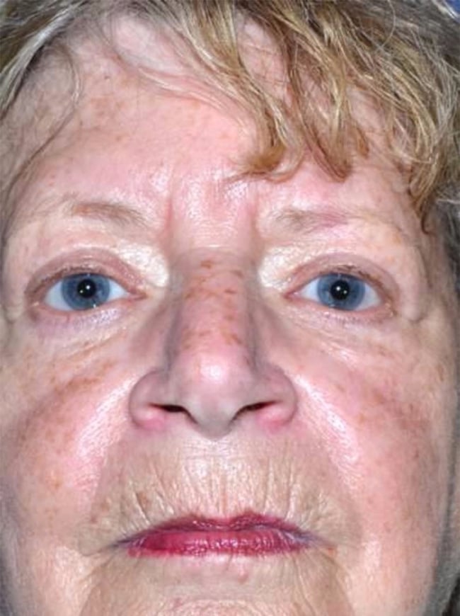 After Image: Blepharoplasty - front
