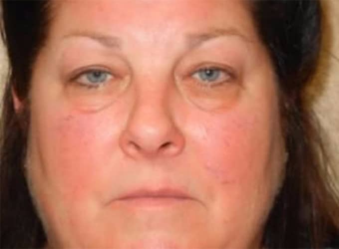 Before Image: Blepharoplasty - front