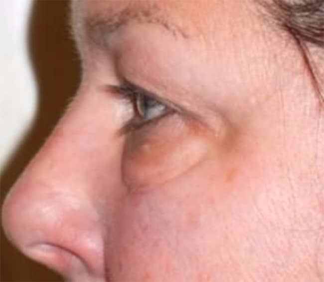 Before Image: Blepharoplasty - left-side