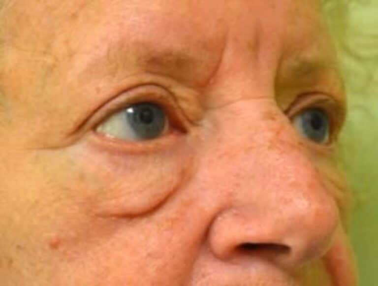 Before Image: Blepharoplasty - right-front-oblique