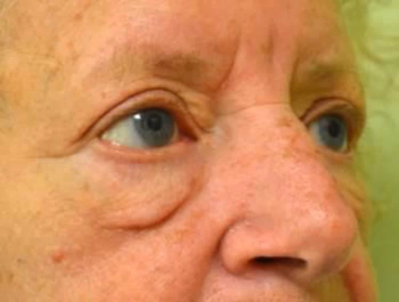Before Image: Blepharoplasty - right-front-oblique