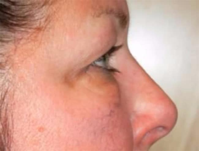 Before Image: Blepharoplasty - right-side