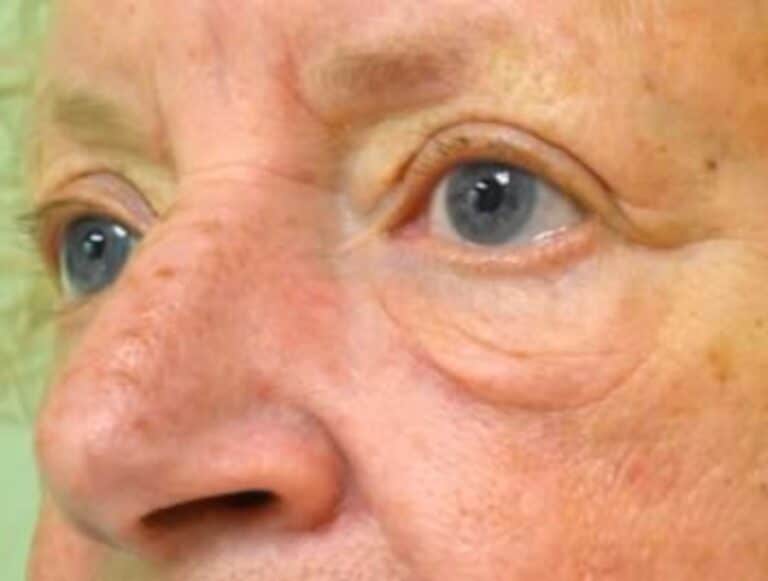 Before Image: Blepharoplasty - left-front-oblique