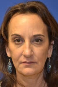 After Image: Dermal Filler