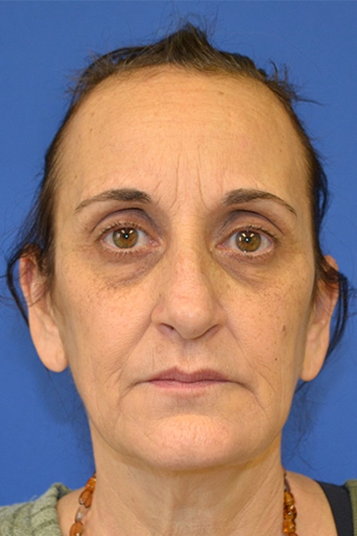 Before Image: Dermal Filler - front