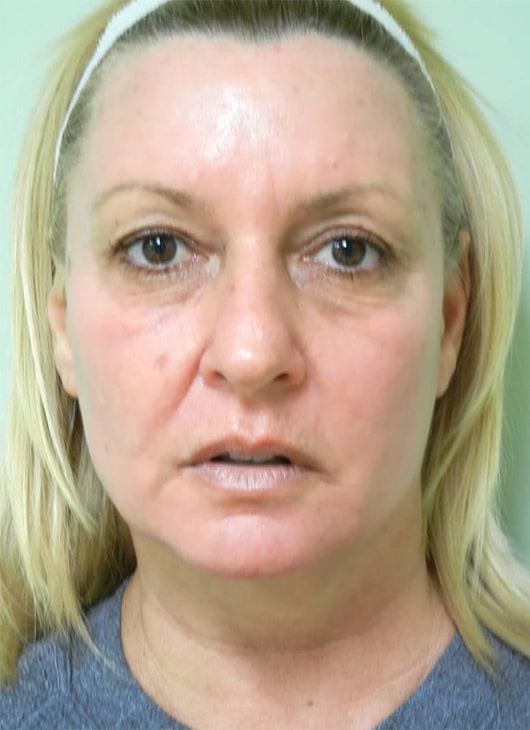 After Image: Fractional Non-Ablative Laser Resurfacing - front