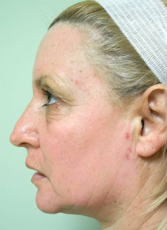 After Image: Fractional Non-Ablative Laser Resurfacing - left-side