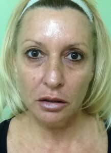 Before Image: Fractional Non-Ablative Laser Resurfacing