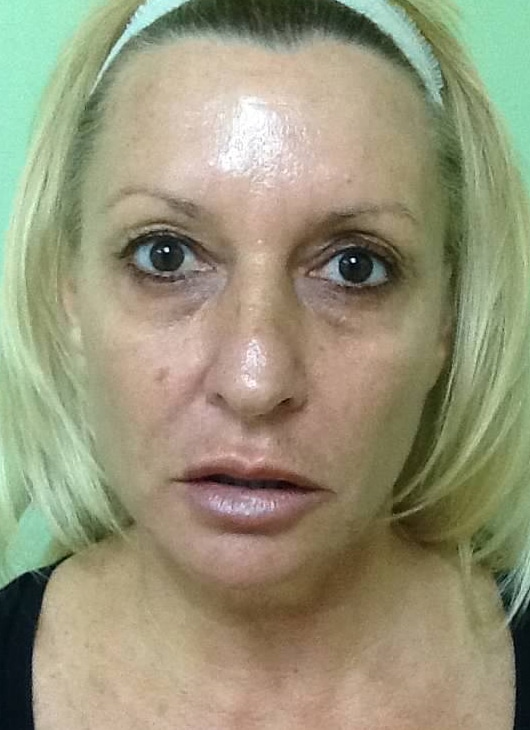 Before Image: Fractional Non-Ablative Laser Resurfacing - front